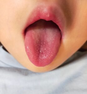 うちの子、低舌位かも？放置するとどうなる？特徴や改善方法を解説